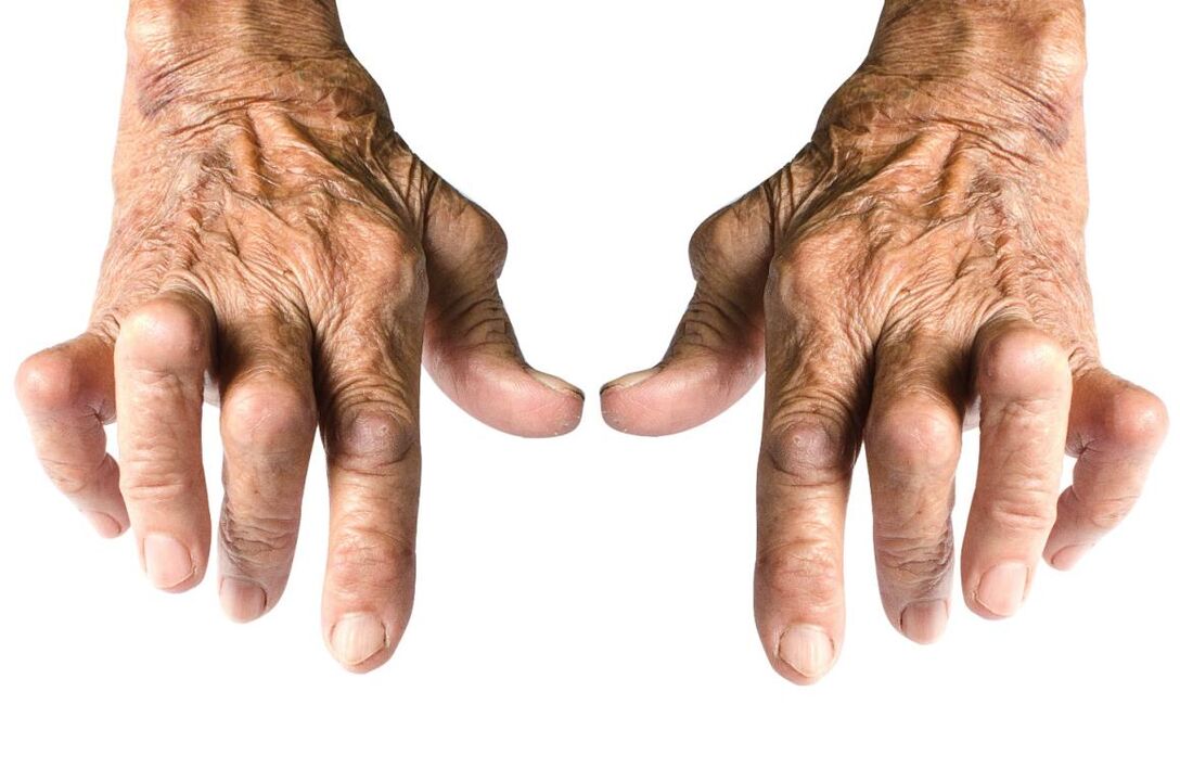 artrīta pazīmes – locītavu deformācija
