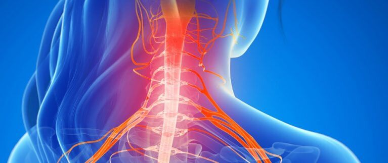 Muguras smadzeņu asinsvadu saspiešana mugurkaula kakla osteohondrozē