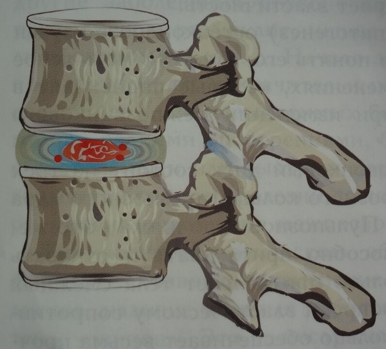Starpskriemeļu diska pulposa kodola bojājumi dzemdes kakla osteohondrozes pirmajā stadijā