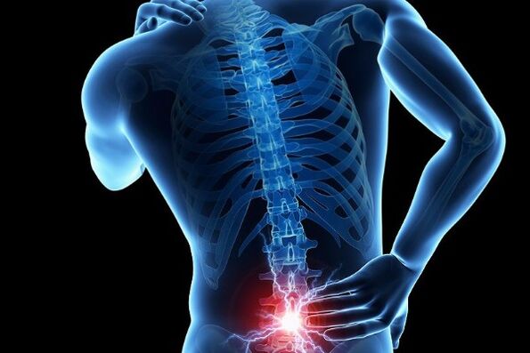 Akūtas sāpes muguras lejasdaļā ir starpskriemeļu disku pārvietošanās simptoms