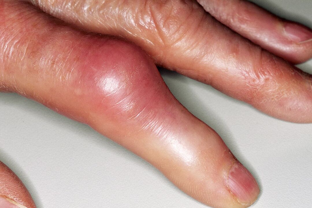 Pietūkums, pirkstu locītavas deformācija un akūtas sāpes pēc traumas