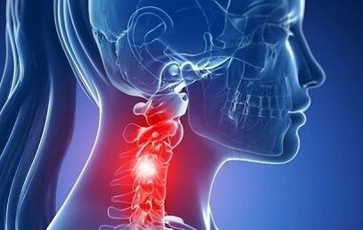 Kakla osteohondroze