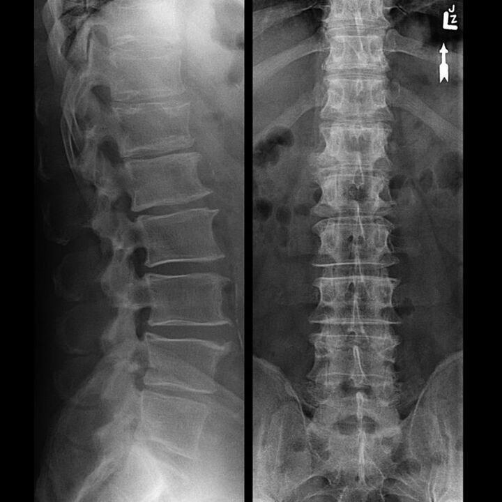 Mugurkaula snapēšana ar osteohondrozi